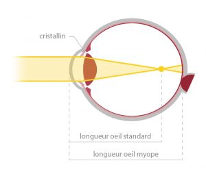 Votre correction : schéma de la myopie - opticien à Nîmes La Belle Vision