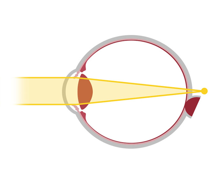 Votre correction : schéma de la presbytie - opticien à Nîmes La Belle Vision