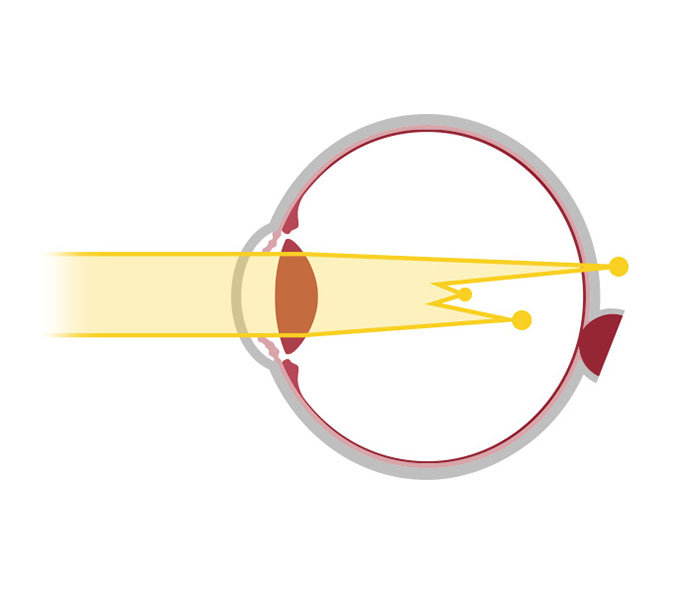 Votre correction : schéma de la astygmatie - opticien à Nîmes La Belle Vision