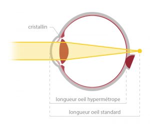 Votre correction : schéma de la hypermétropie - opticien à Nîmes La Belle Vision