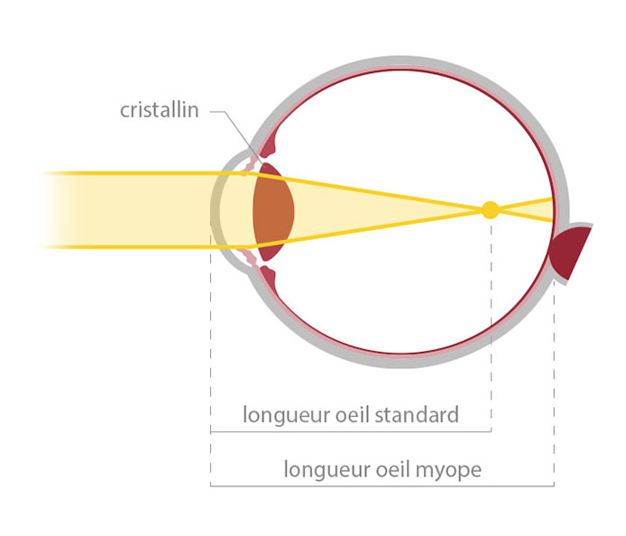 Votre correction : schéma de la myopie – opticien à Nîmes La Belle Vision Votre correction : schéma de la myopie - opticien à Nîmes La Belle Vision