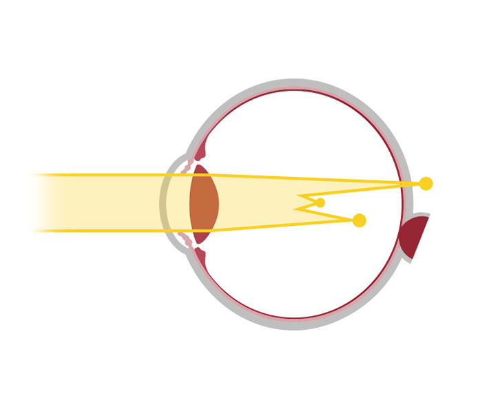 Votre correction : schéma de la astygmatie – opticien à Nîmes La Belle Vision Votre correction : schéma de la astygmatie - opticien à Nîmes La Belle Vision